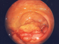 大腸癌症例