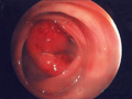 大腸癌症例