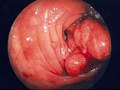 大腸癌症例