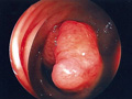 大腸癌症例