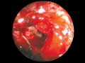 大腸癌症例