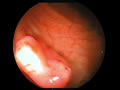大腸癌症例