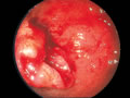 大腸癌症例