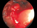 大腸癌症例