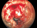 大腸癌症例