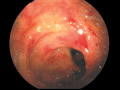 アメーバー性腸炎