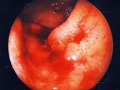 大腸癌症例