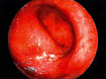 潰瘍性大腸炎