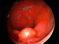 アメーバー性大腸炎