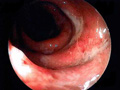 潰瘍性大腸炎
