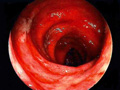 潰瘍性大腸炎
