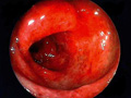 潰瘍性大腸炎