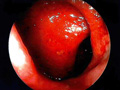 潰瘍性大腸炎