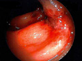 虚血性腸炎
