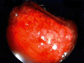 虚血性腸炎