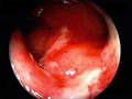 虚血性腸炎