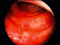 虚血性腸炎