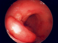 大腸癌症例